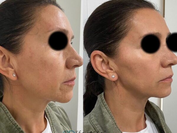 3D Face Lift