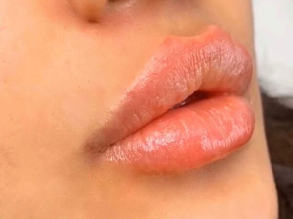 Lip Fillers