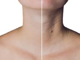 Botox - Neck Wrinkles (Necklace Lines)